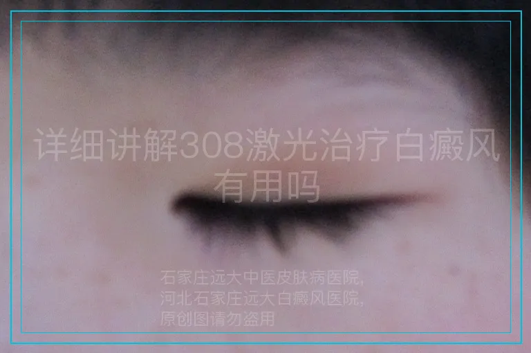 详细讲解308激光治疗白癜风有用吗