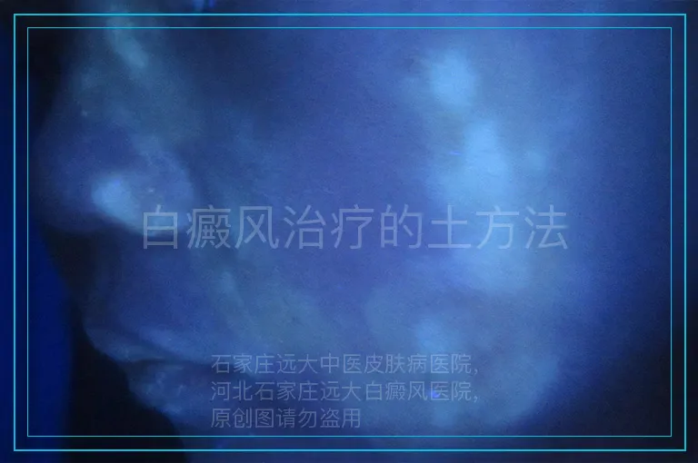 白癜风治疗的土方法