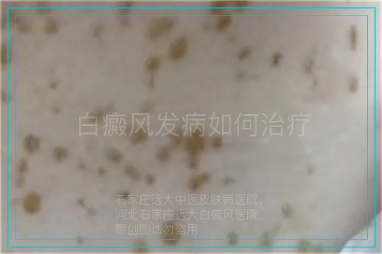 白癜风发病如何治疗