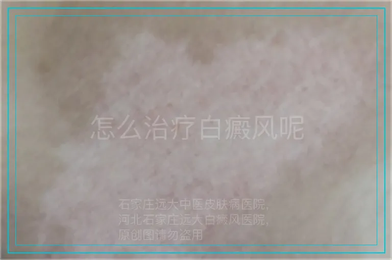 怎么治疗白癜风呢