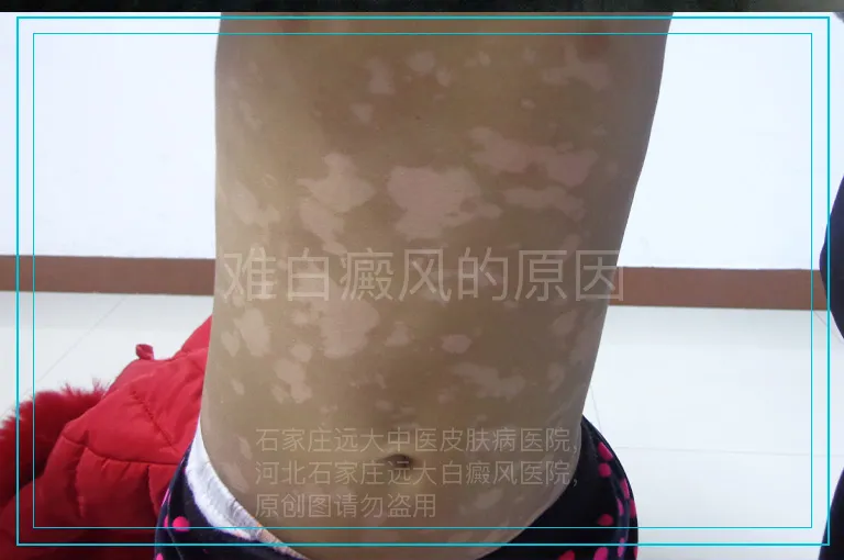 难白癜风的原因