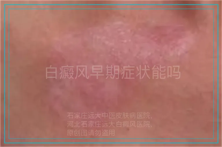 白癜风早期症状能吗