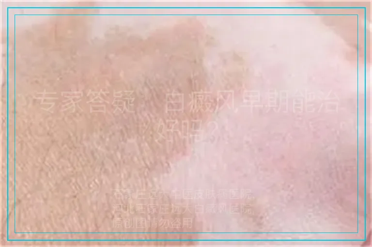 专家答疑:白癜风早期能治好吗?