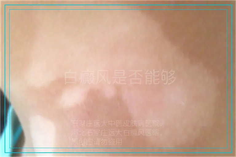 白癜风是否能够