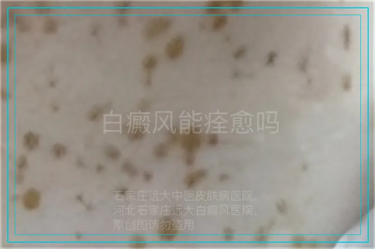 白癜风能痊愈吗