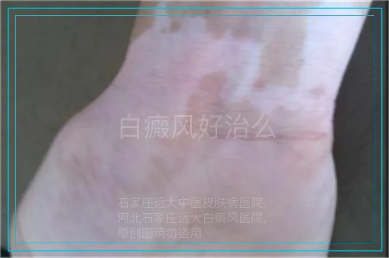 白癜风好治么