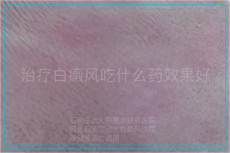 治疗白癜风吃什么药效果好