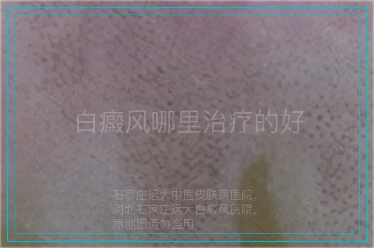 白癜风哪里治疗的好
