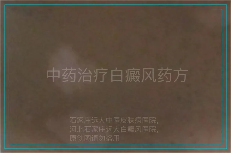 中药治疗白癜风药方