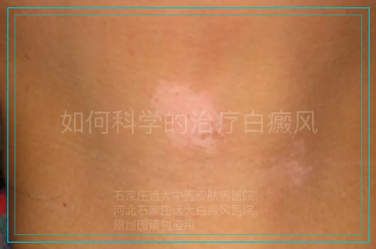如何科学的治疗白癜风