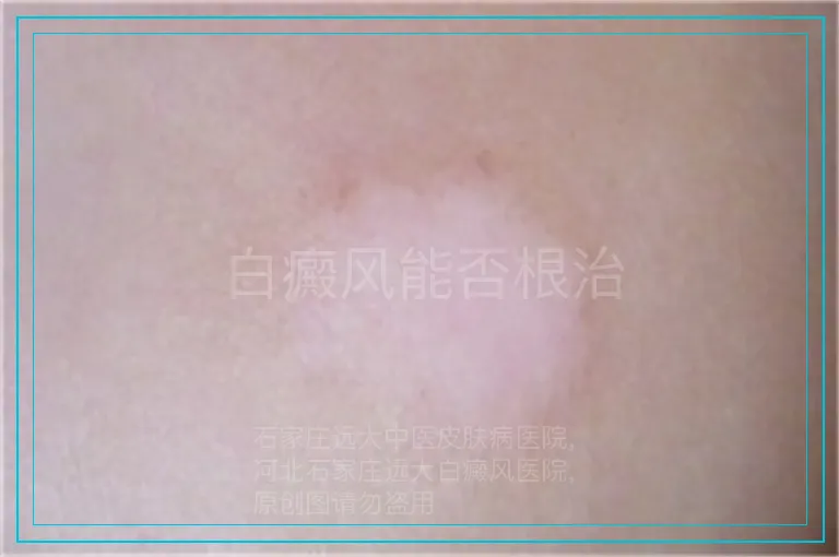 白癜风能否根治