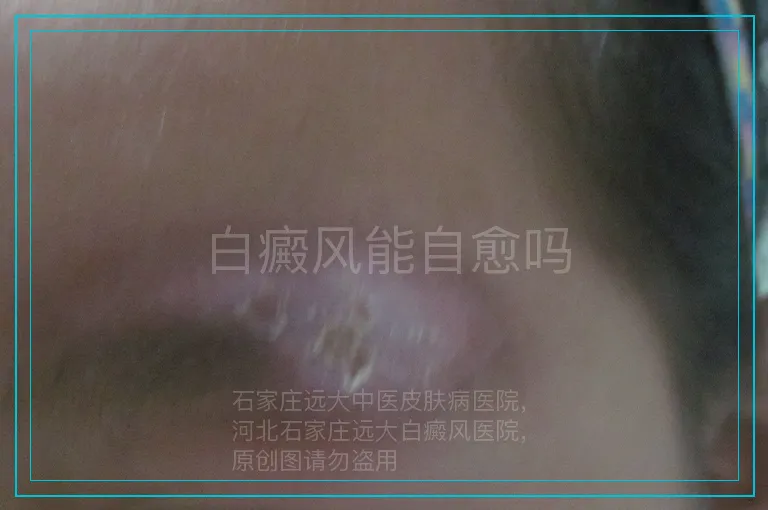 白癜风能自愈吗