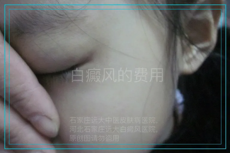 白癜风的费用