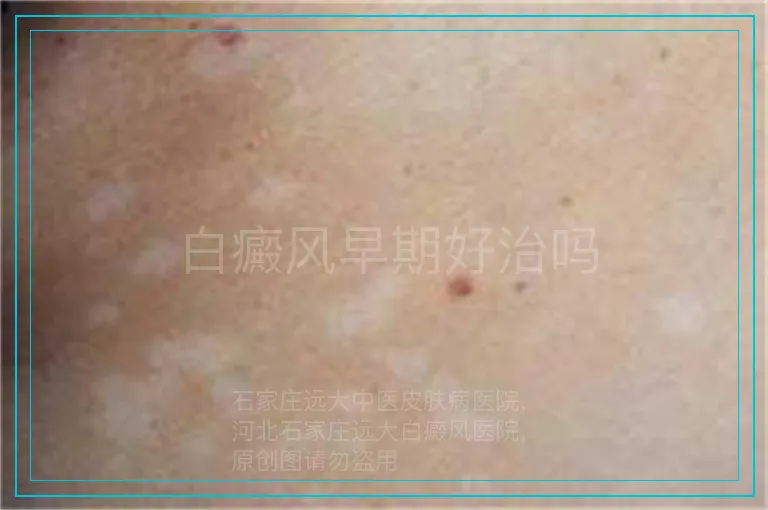 白癜风早期好治吗
