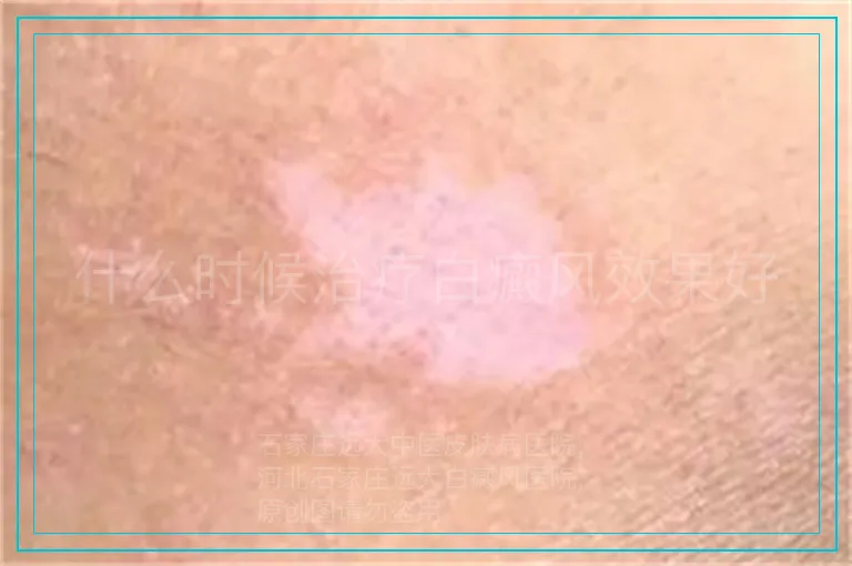 什么时候治疗白癜风效果好
