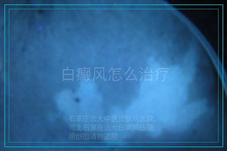 白癜风怎么治疗