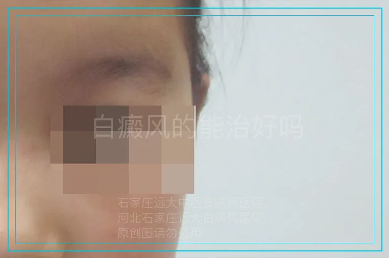白癜风的能治好吗