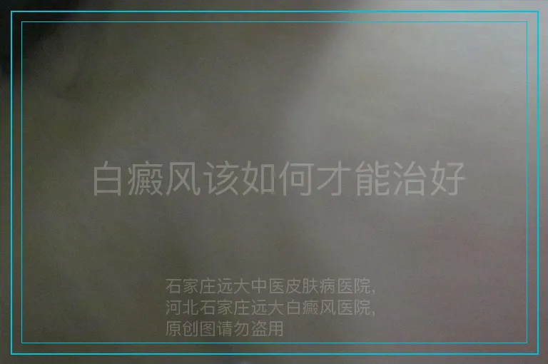 白癜风该如何才能治好
