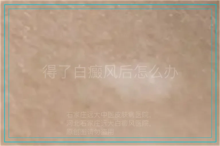 得了白癜风后怎么办