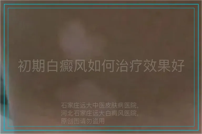 初期白癜风如何治疗效果好
