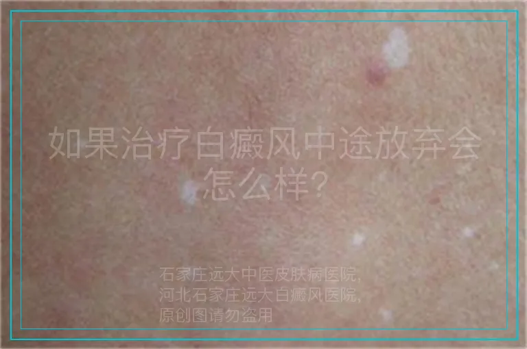 如果治疗白癜风中途放弃会怎么样?