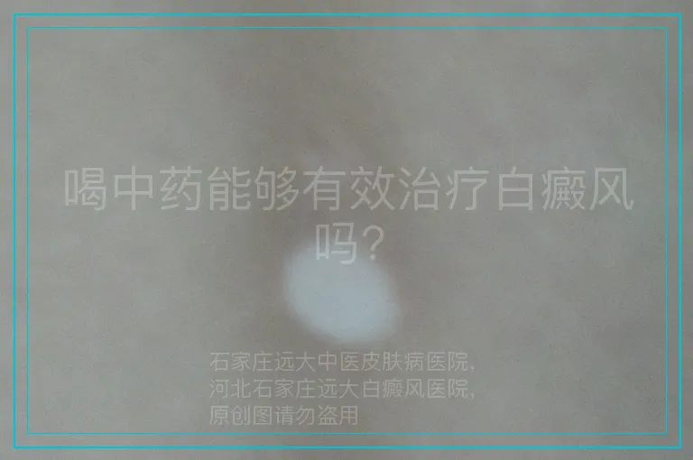 喝中药能够有效治疗白癜风吗?