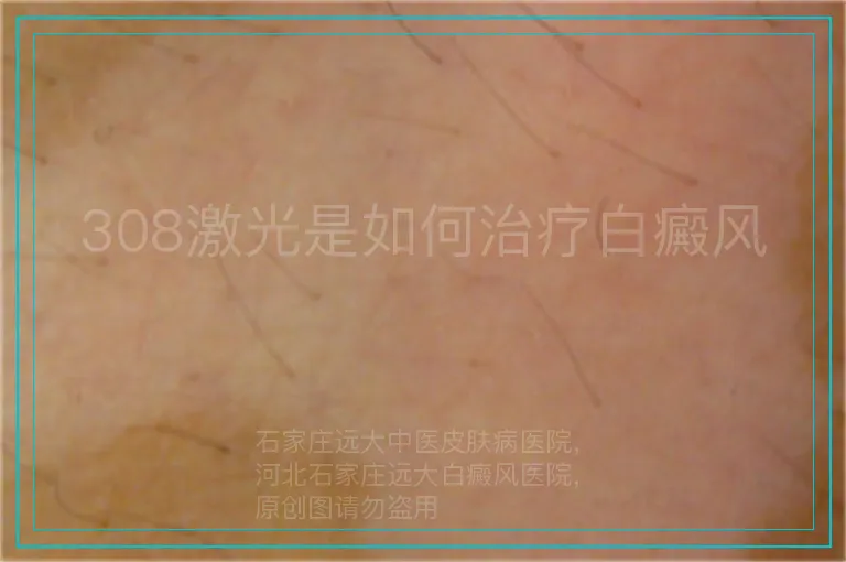 308激光是如何治疗白癜风