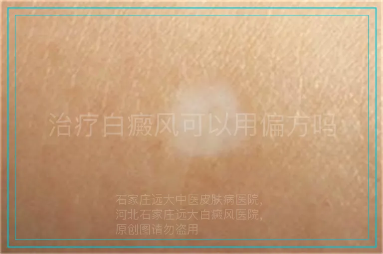 治疗白癜风可以用偏方吗