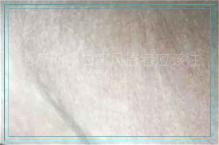 治疗期间白癜风患者应该注意什么
