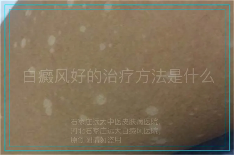 白癜风好的治疗方法是什么