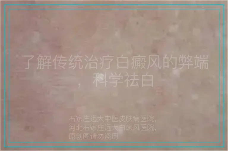 了解传统治疗白癜风的弊端，科学祛白