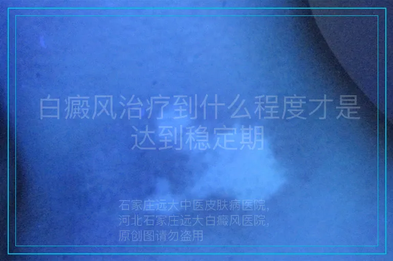 白癜风治疗到什么程度才是达到稳定期