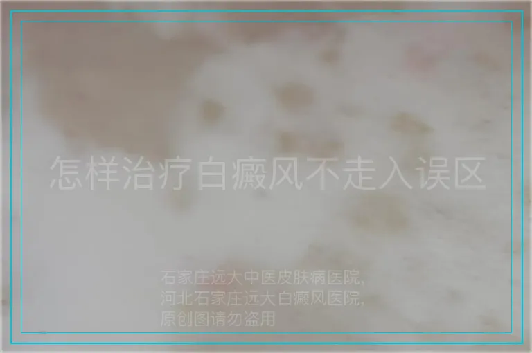 怎样治疗白癜风不走入误区