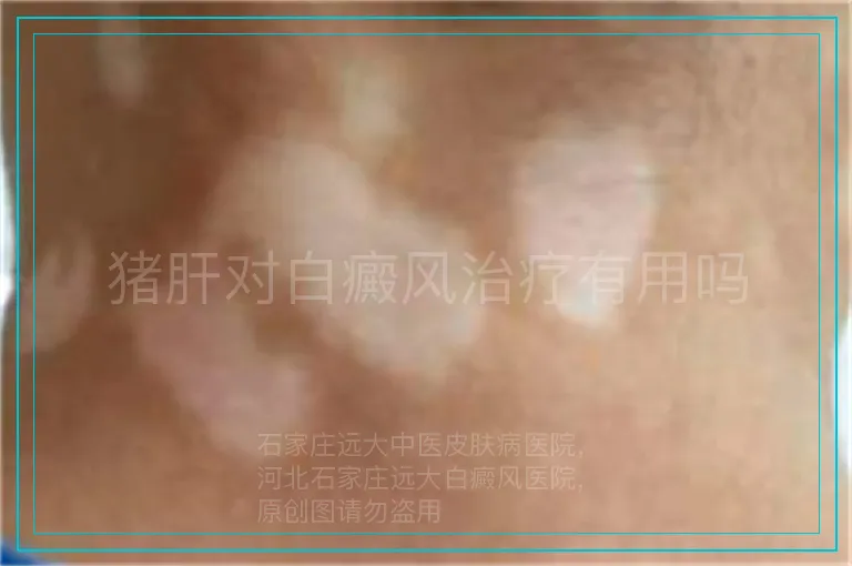 猪肝对白癜风治疗有用吗