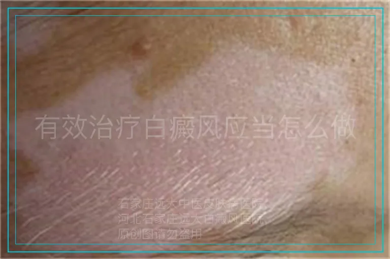 有效治疗白癜风应当怎么做