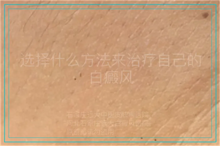 选择什么方法来治疗自己的白癜风