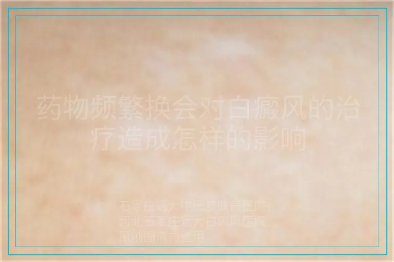 药物频繁换会对白癜风的治疗造成怎样的影响