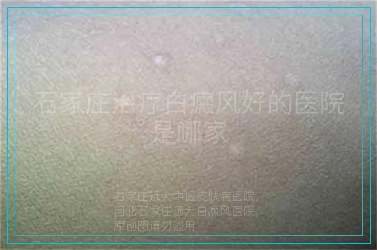 石家庄治疗白癜风好的医院是哪家