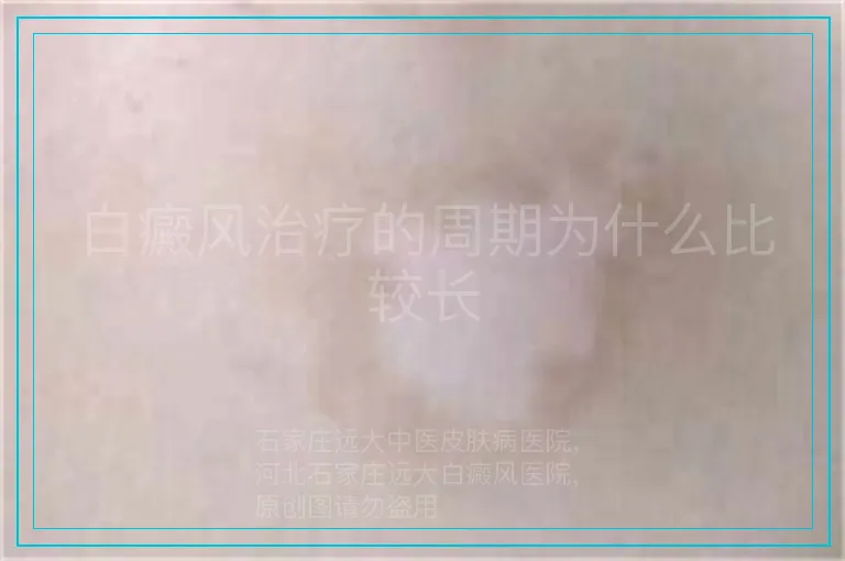 白癜风治疗的周期为什么比较长