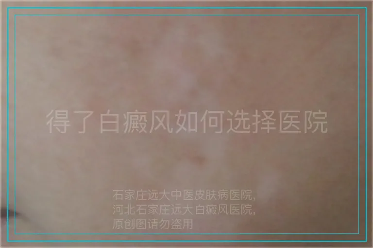 得了白癜风如何选择医院