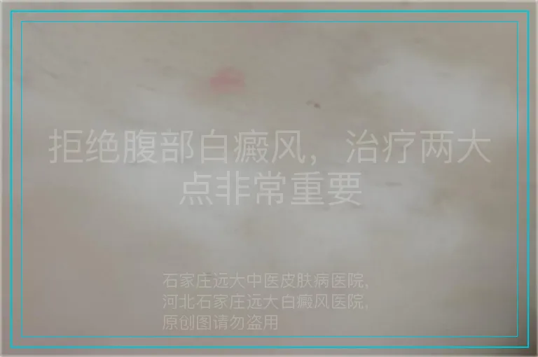 拒绝腹部白癜风,治疗两大点非常重要