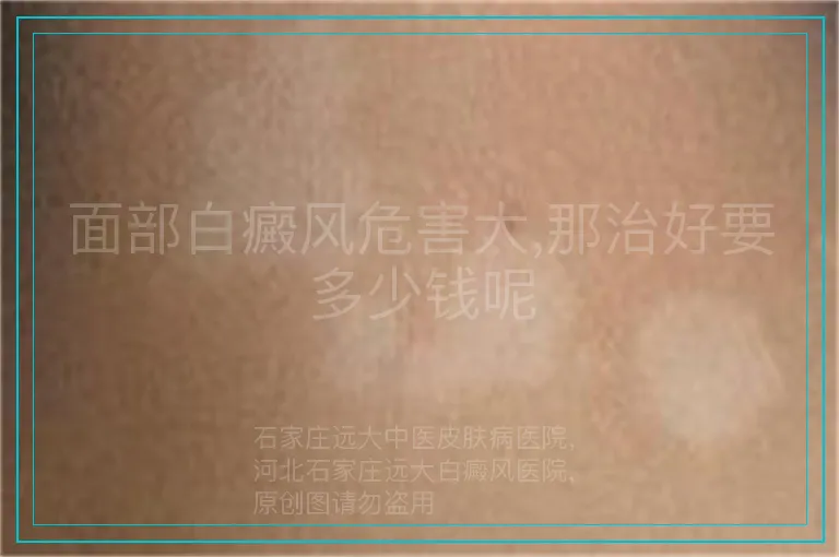 面部白癜风危害大,那治好要多少钱呢