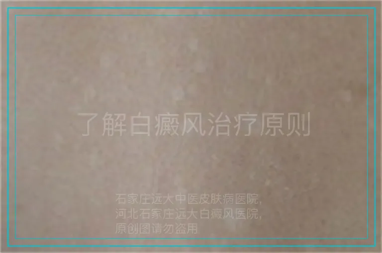了解白癜风治疗原则