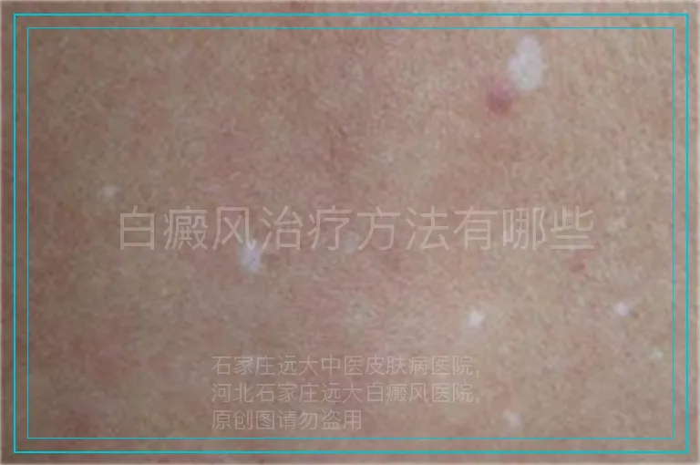 白癜风治疗方法有哪些