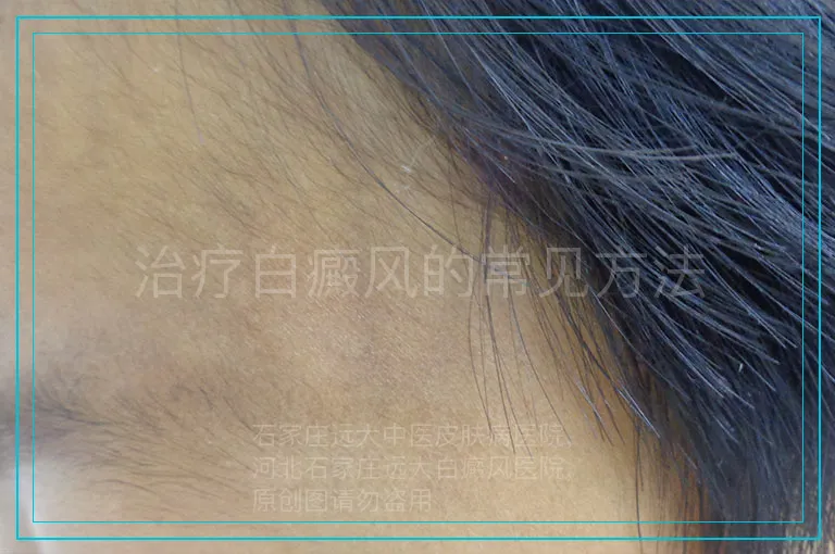 治疗白癜风的常见方法