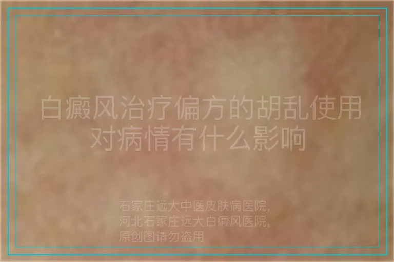 白癜风治疗偏方的胡乱使用对病情有什么影响
