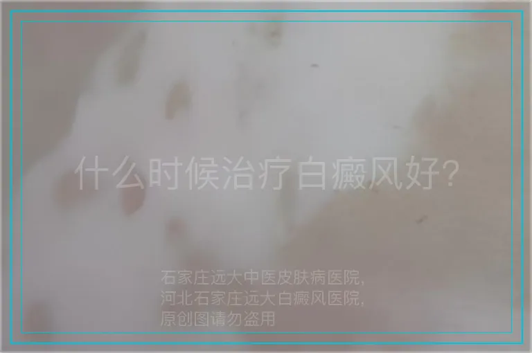 什么时候治疗白癜风好?