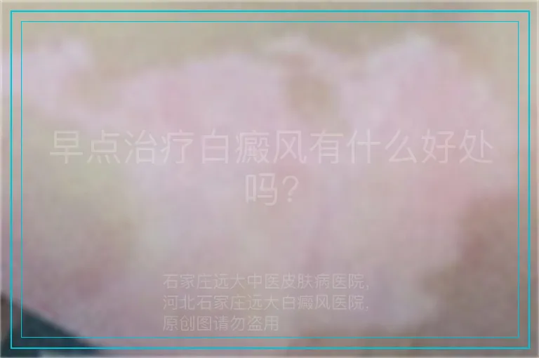 早点治疗白癜风有什么好处吗?