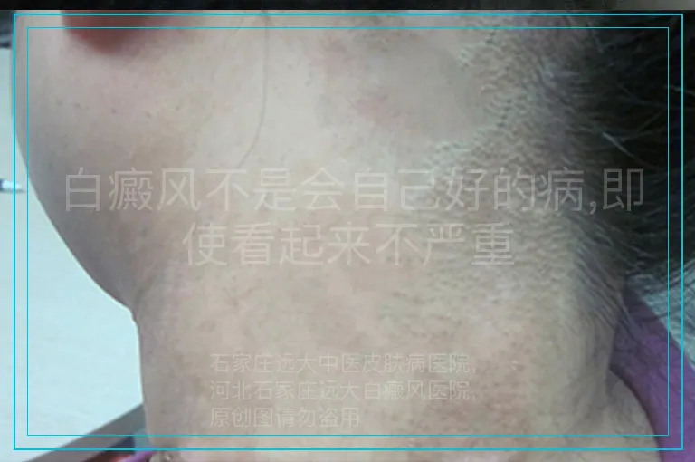 白癜风不是会自己好的病,即使看起来不严重