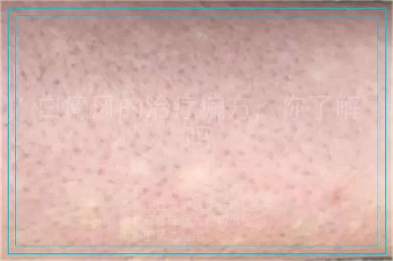 白癜风的治疗偏方,你了解吗
